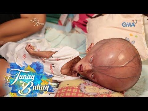 Tunay na Buhay: Sanggol na may hydranencephaly, paano lumalaban? (with English subtitles)