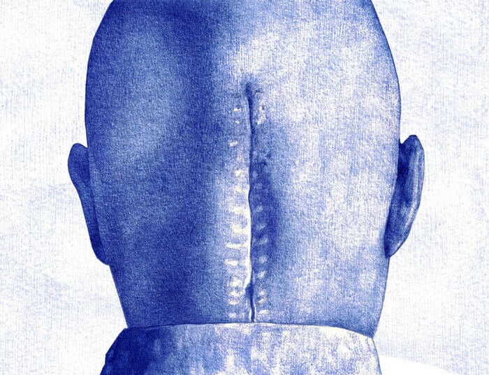 A bald human head shown from behind. A scar runs up the length of it.