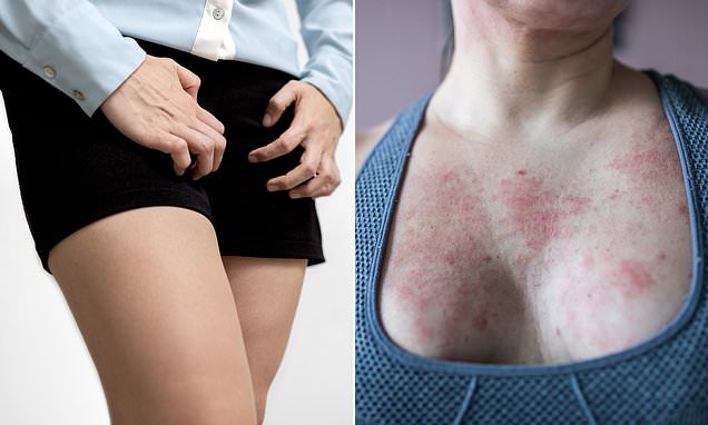 Study suggests 6 million American women could have genital ECZEMA but don't know it -