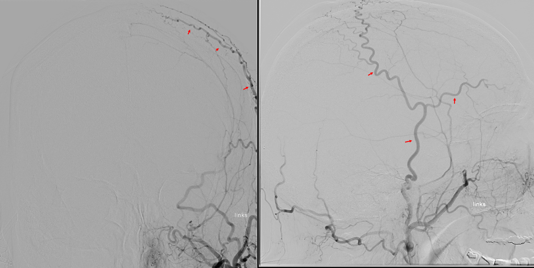 r/Radiology - Angiography Image of the superficial temporal artery (STA)