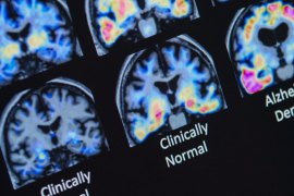 Regular scans will be needed to monitor the brains of those taking the new Alzheimer’s drug Leqembie.