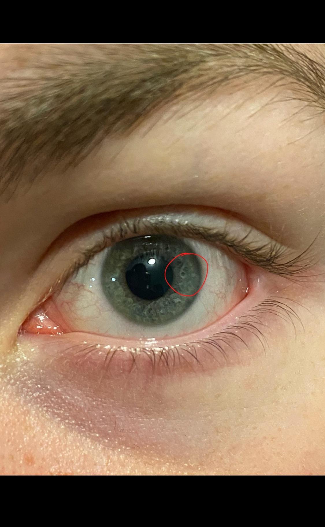 r/Weird - My Bf’s left eye has a 6 in it