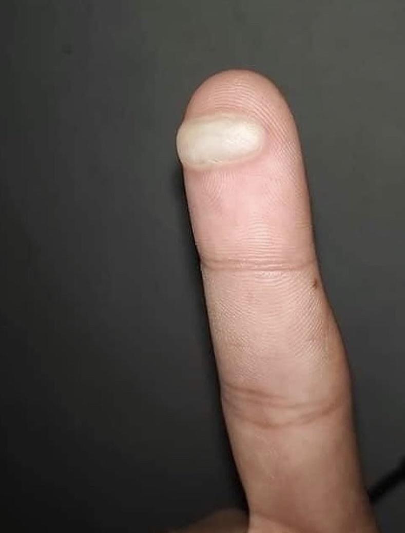 r/notinteresting - I burnt my finger for the second time, now what?