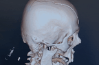 a CT scan showing a gunshot would in the skull.