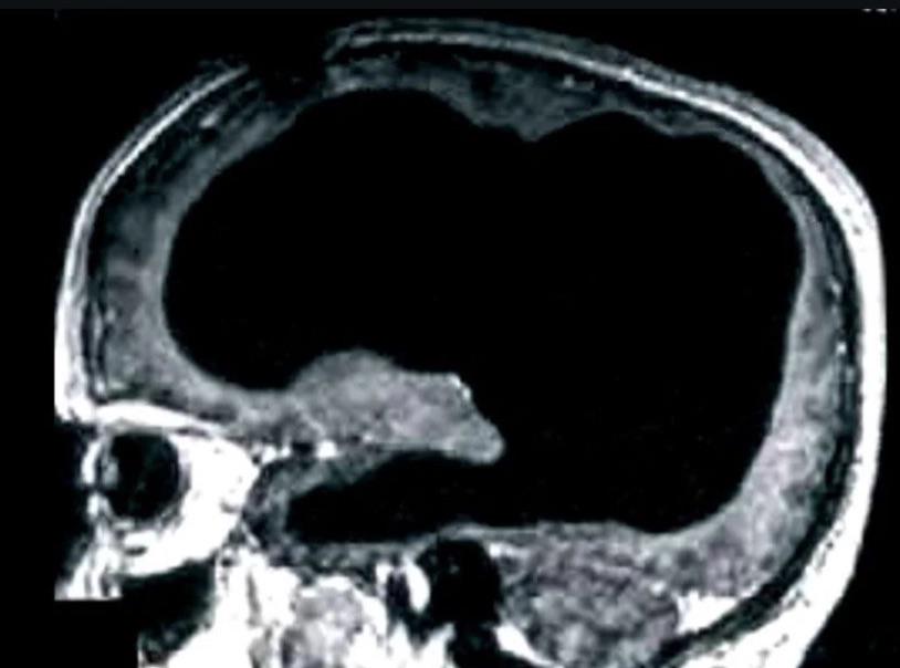 r/interestingasfuck - A man was discovered to be unknowingly missing 90% of his brain, yet he was living a normal life.