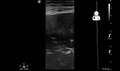 File:UOTW 34 - Ultrasound of the Week 2.webm