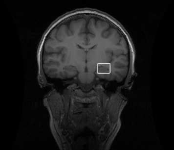 Structural brain image of the location of the magnetic resonance spectroscopy acquisition in left hippocampus. 