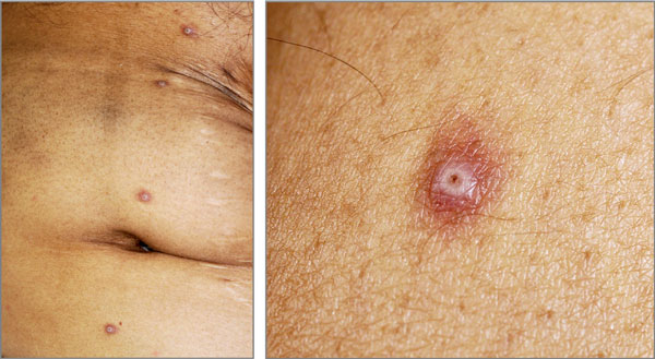 Perforating Papules in a Patient With Acute Myeloid Leukemia