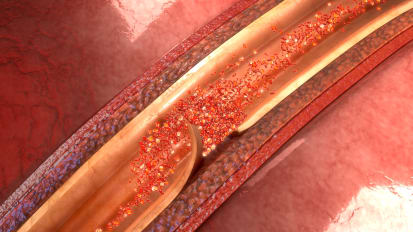 Spontaneous Coronary Artery Dissection (SCAD)