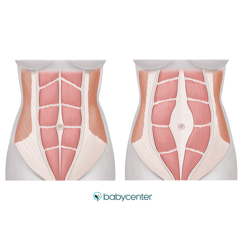 abdominal muscles - normal and with diastasis recti