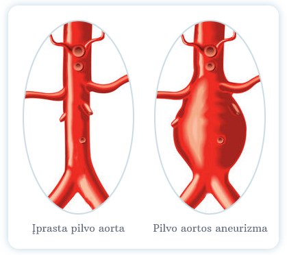 Aortos aneurizma: simptomai ir gydymas