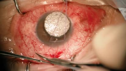 Left Baerveldt-350 glaucoma drainage device implantation with cornea patch graft