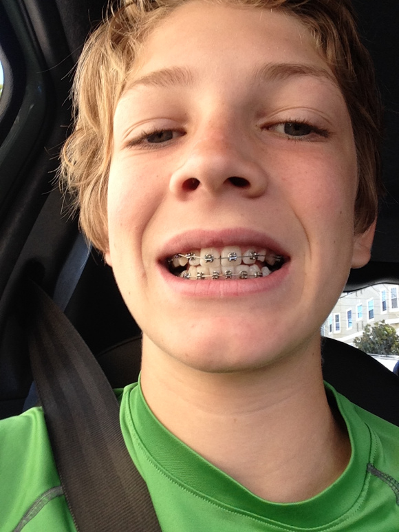 Diane: Owen with his new braces!