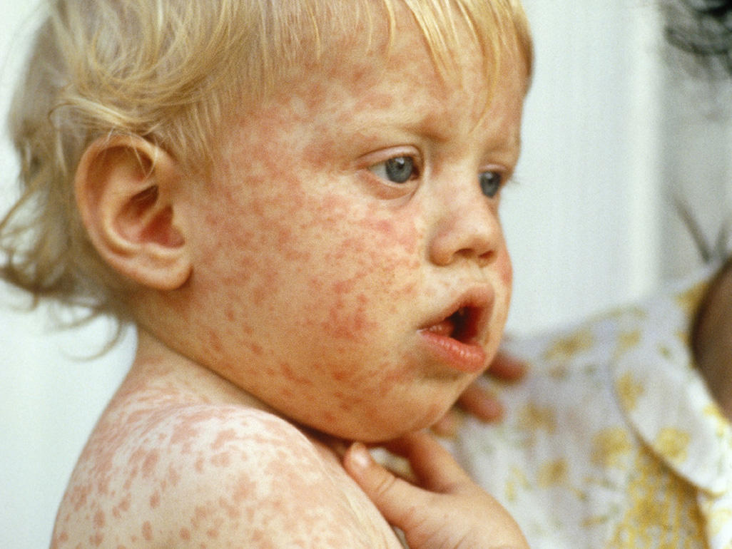 Childhood rashes, skin conditions and infections