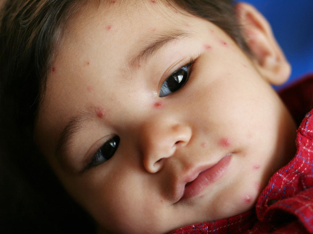 Baby with rash on face