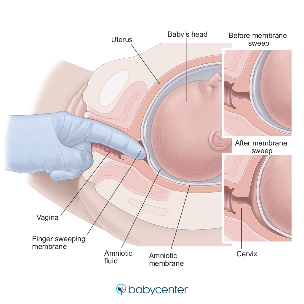 medical illustration of membrane sweeping to induce labor