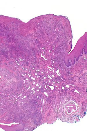 Traumatic ulcerative granuloma with stromal eosinophils - alt -- extremely low mag.jpg