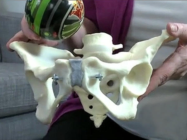 Child's ball the size of a baby's head in an artificial pelvis