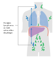 Stage 3 Hodgkin lymphoma