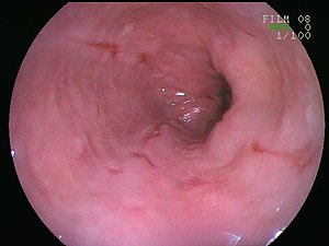 Esophageal ulcer.jpg