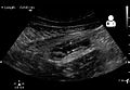 Ultrasound showing appendicitis and an appendicolith[55]