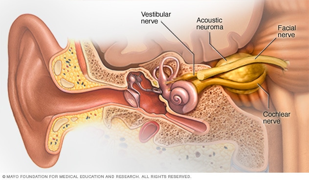 Acoustic neuroma