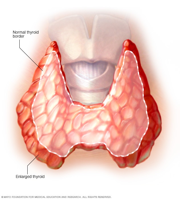 Enlarged thyroid