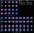 Nuclear medicine myocardial perfusion scan with thallium-201 for the rest images (bottom rows) and Tc-Sestamibi for the stress images (top rows). The nuclear medicine myocardial perfusion scan plays a pivotal role in the noninvasive evaluation of coronary artery disease. The study not only identifies patients with coronary artery disease; it also provides overall prognostic information or overall risk of adverse cardiac events for the patient.