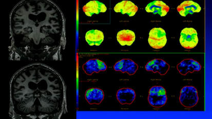 Grand Rounds en Español: Demencias Degenerativas No Alzheimer