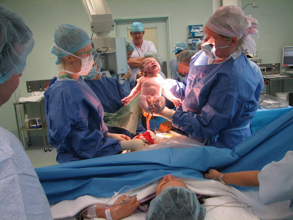 Woman having a caesarean section operation in theatre