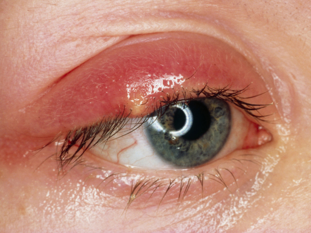 childs eye with swollen upper lid