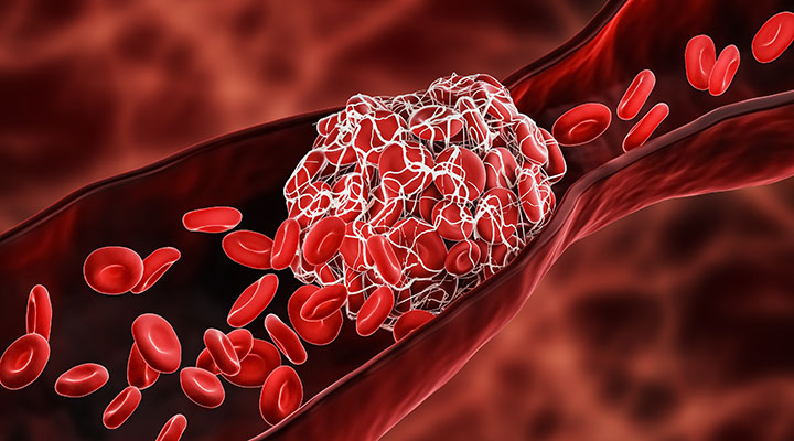 Illustration of blood clot blocking the red blood cells stream 