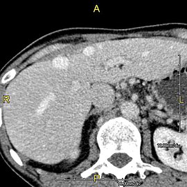 Axial CT image showing anomalous hepatic veins coursing on the liver's subcapsular anterior surface[65]