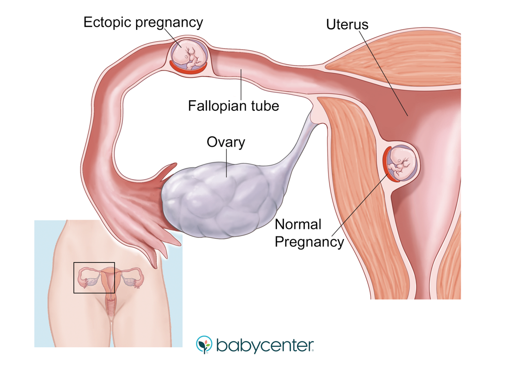 illustration showing an ectopic pregnancy