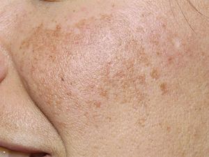 woman with melasma (skin darkening) on face 