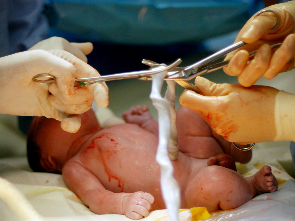 Baby having umbilical cord clamped