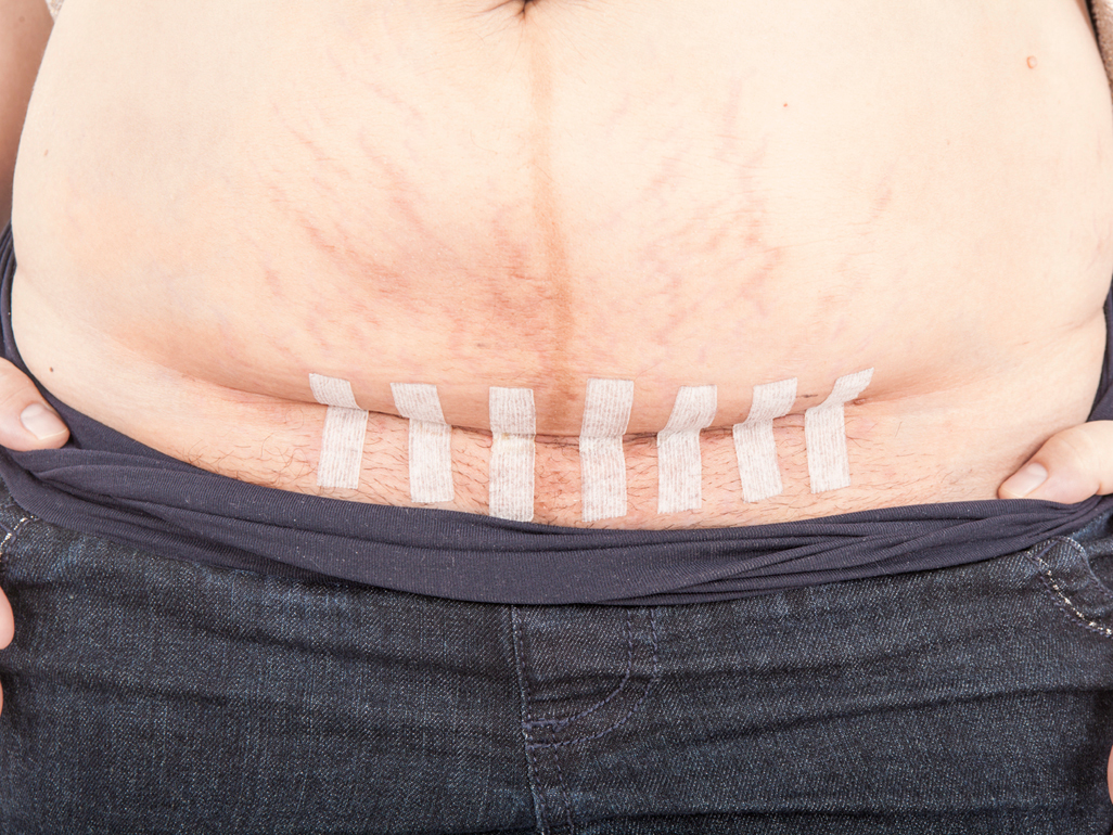 woman with C-section scar covered by medical tape