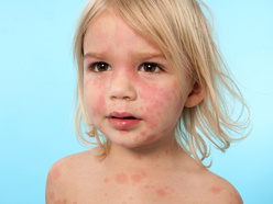 child with rash