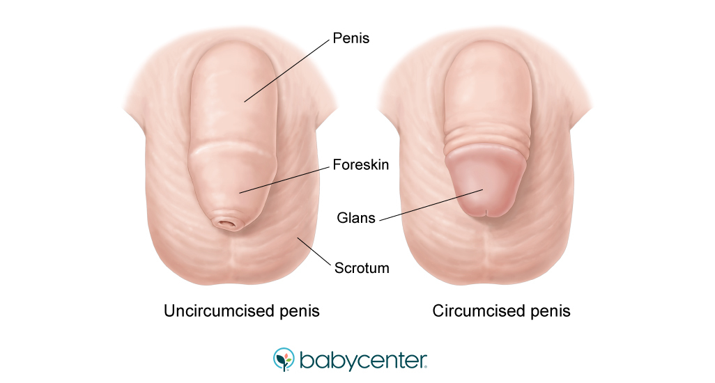 Illustration comparing uncircumcised and circumcised baby boy's penis