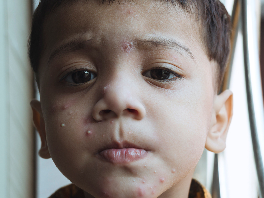 Child with chickenpox on his face