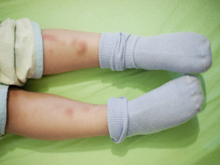 Child's legs with bruises