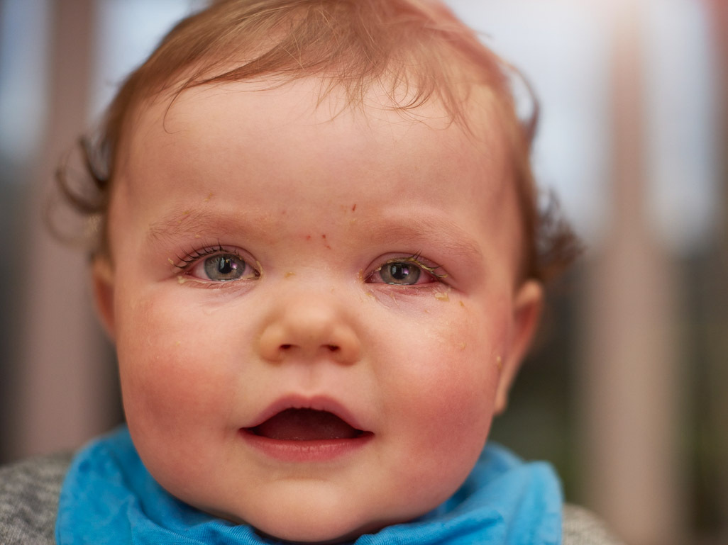 A baby with pinkeye symptoms, text reads: BabyCenter Answers, Pinkeye in babies