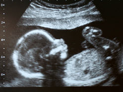 ultrasound image of baby in the womb