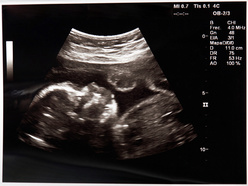 Ultrasound scan picture