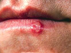 Lippenherpes