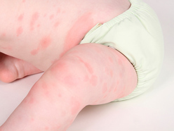 Child with hives rash on trunk