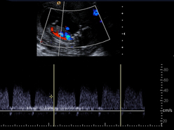 Doppler scan image on a screen