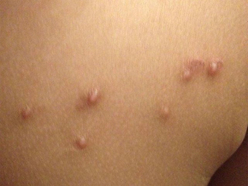 Molluscum contagiosum (water warts)