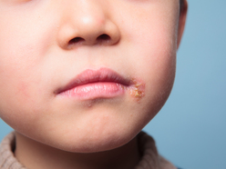 Child's face with cold sore