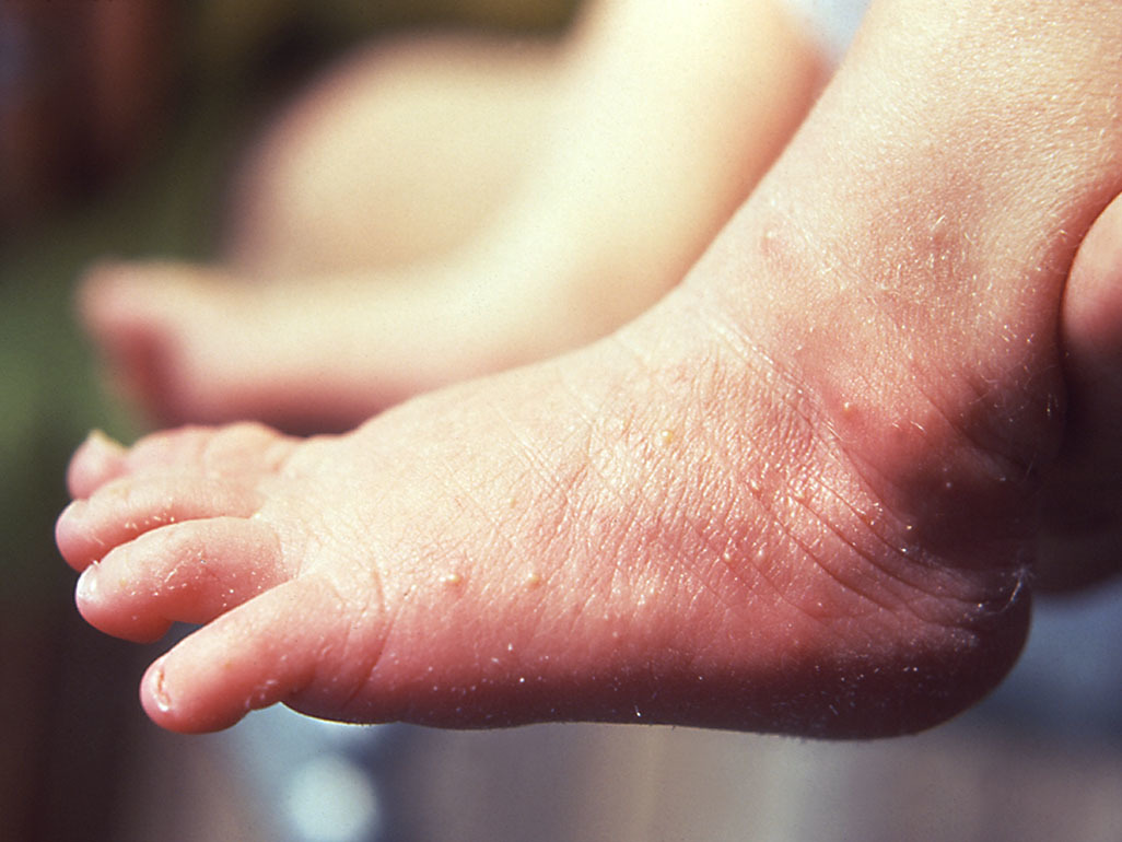 baby foot with a dozen small skin-colored bumps